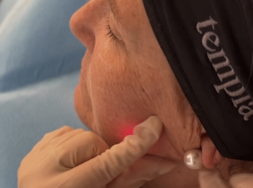 Mujer con tratamiento de endolift facial